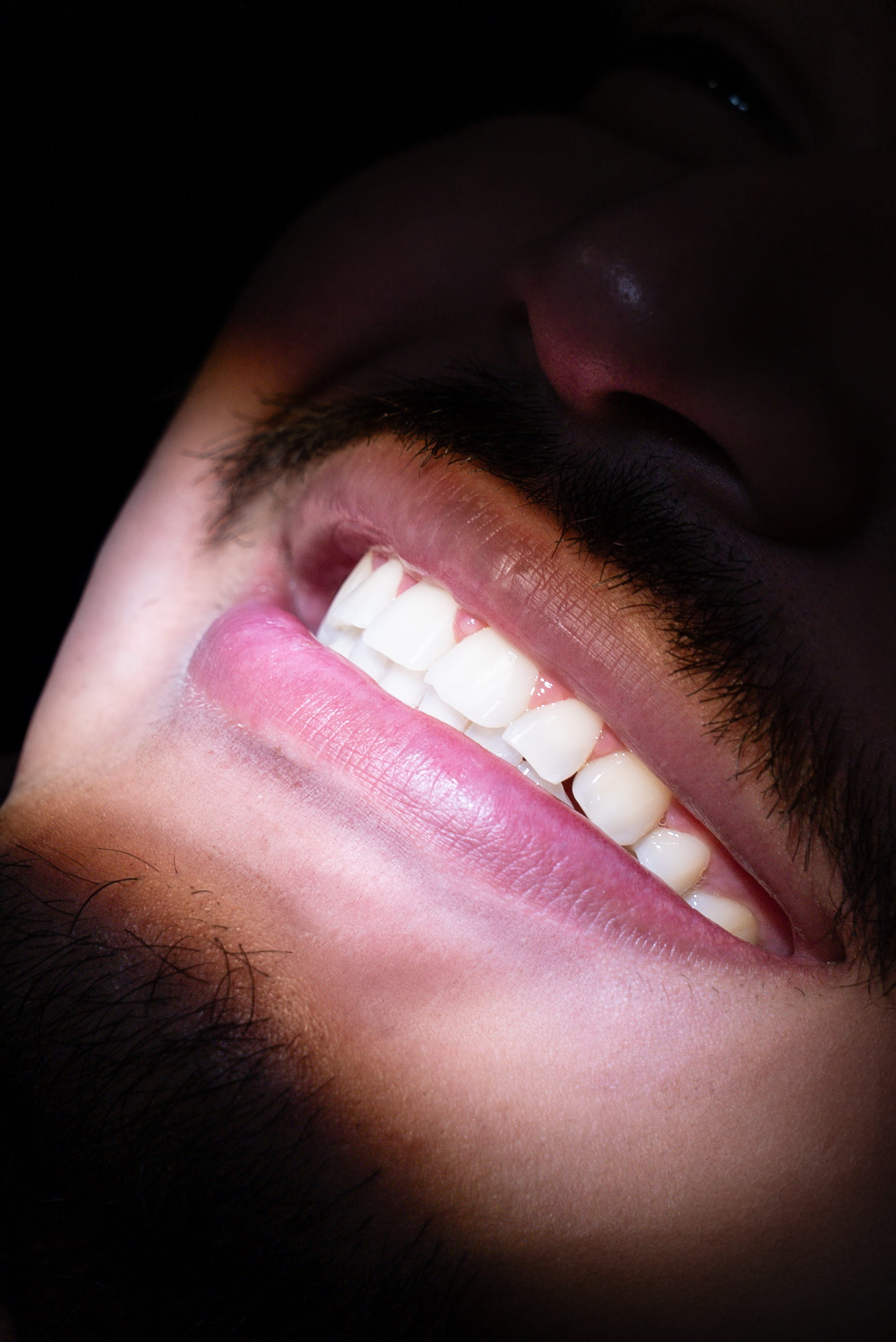 Teeth Whitening